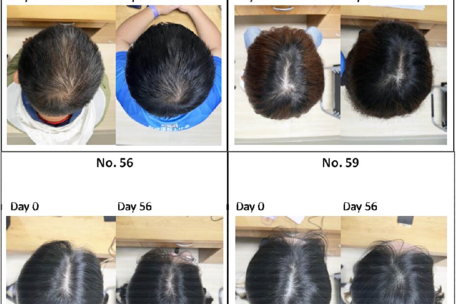 Bệnh hói đầu sắp ”tuyệt chủng” đến nơi: Huyết thanh từ thực vật giúp tóc dày lên 25% chỉ trong 56 ngày